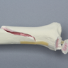 Tibia with Condylar, Malleolar, Oblique, and Spiral Fractures
