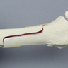 Tibia with Condylar, Malleolar, Oblique, and Spiral Fractures