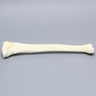 Tibia with "Y" Fracture