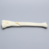 Tibia with Condylar and Oblique Fractures
