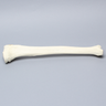 Tibia with Condylar Fracture and Fragment
