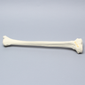 Tibia with Condylar Fracture and Fragment