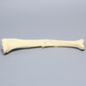 Tibia with Butterfly Fracture