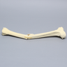 Tibia with Butterfly Fracture