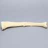 Tibia with Butterfly Fracture