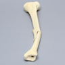 Tibia with Butterfly Fracture