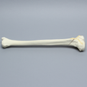 Tibia with Bicondylar and Oblique Fractures