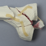 Tibia with Bicondylar and Oblique Fractures