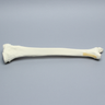 Tibia and Fibula with Spiral Fracture