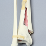 Tibia and Fibula with Spiral Fracture