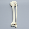 Tibia and Fibula with Bicondylar Fracture