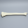 Tibia and Fibula with Bicondylar Fracture