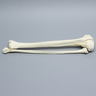 Tibia and Fibula with Bicondylar Fracture