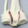 Tibia and Fibula with Bicondylar Fracture
