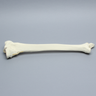 Tibia and Fibula with Bicondylar Fracture