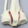 Tibia and Fibula with Bicondylar Fracture