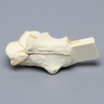 Calcaneus with Five-Part Fracture, Foam Cortical, Left