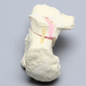 Calcaneus with Four-Part Fracture, Foam Cortical, Left