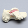 Calcaneus with Four-Part Fracture, Foam Cortical, Left