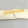 Femur with Light Density Cancellous and Fracture