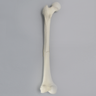 Femur with Light Density Cancellous and Fracture
