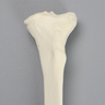 Tibia with Arthritis, Left