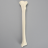 Tibia with Arthritis, Left