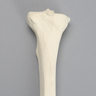 Tibia with Arthritis, Left