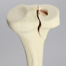 Tibia with Condylar Fracture and Fragment, Right, Medium