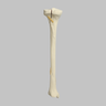 Tibia with Plateau, Spiral, and Malleolar Fractures, Left