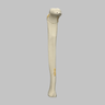 Tibia with Plateau, Spiral, and Malleolar Fractures, Left