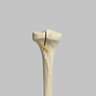 Tibia with Plateau, Spiral, and Malleolar Fractures, Left