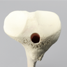 Tibia with 12 mm Canal, Oblique Fracture for IM Nail
