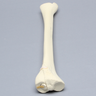 Tibia with Displaced Condylar Fracture and Fragment