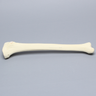 Tibia with Displaced Condylar Fracture and Fragment