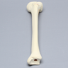 Tibia with Displaced Condylar Fracture and Fragment