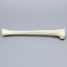 Tibia with Displaced Condylar Fracture and Fragment