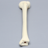Tibia with Displaced Condylar Fracture and Fragment