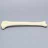 Tibia with Displaced Condylar Fracture and Fragment