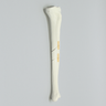 Tibia with Segmental Fracture, Solid Foam, Left, Medium