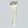 Tibia with Segmental Fracture, Solid Foam, Left, Medium