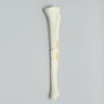 Tibia with Segmental Fracture, Solid Foam, Left, Medium