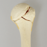 Humerus with Four-Part Bicipital Groove Fracture, Foam Cortical, Right