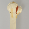 Humerus with Four-Part Bicipital Groove Fracture, Foam Cortical, Right