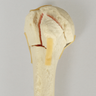 Humerus with Four-Part Bicipital Groove Fracture, Foam Cortical, Right