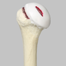 Humerus Replacement with Hill-Sachs Lesion