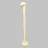 Humerus Replacement with Hill-Sachs Lesion