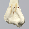 Humerus with Distal "T" Fracture, Foam Cortical