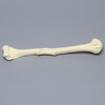Humerus with Butterfly Fracture, Foam Cortical