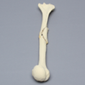 Humerus with Butterfly Fracture, Foam Cortical